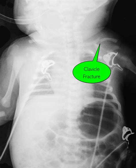 halo sign csf|UMEM Educational Pearls